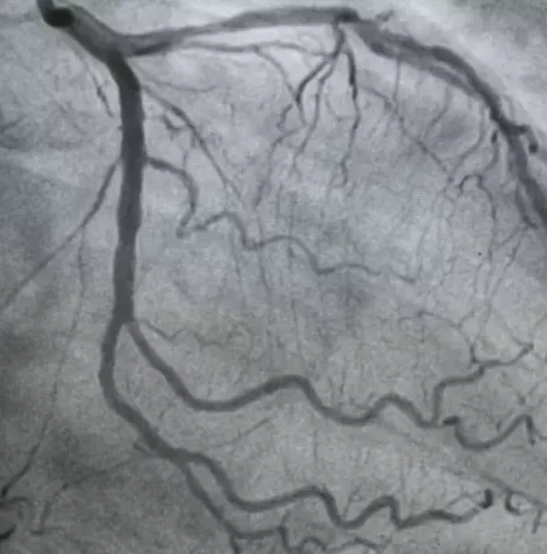 Coronary angiogram showing the coronary arteries filled with contrast dye
