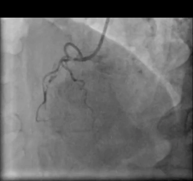 Baseline angiogram of the right coronary artery in LAO 30 degrees, showing chronic total occlusion