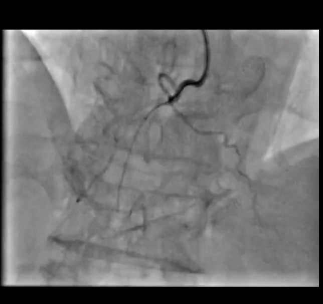 Antegrade guidewire crossing the chronic total occlusion in the right coronary artery