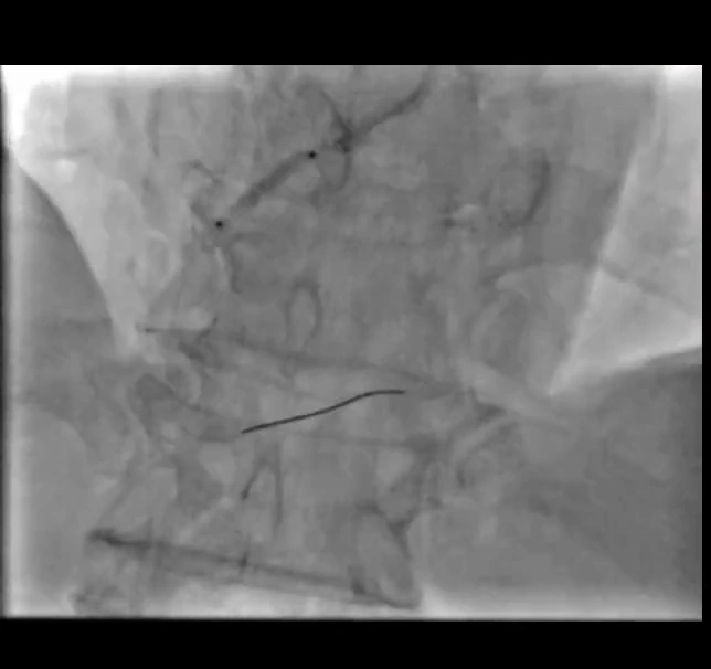 Balloon inflation across the occluded segment during lesion preparation