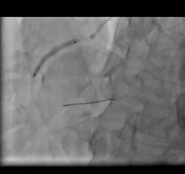 Stent implantation in the right coronary artery