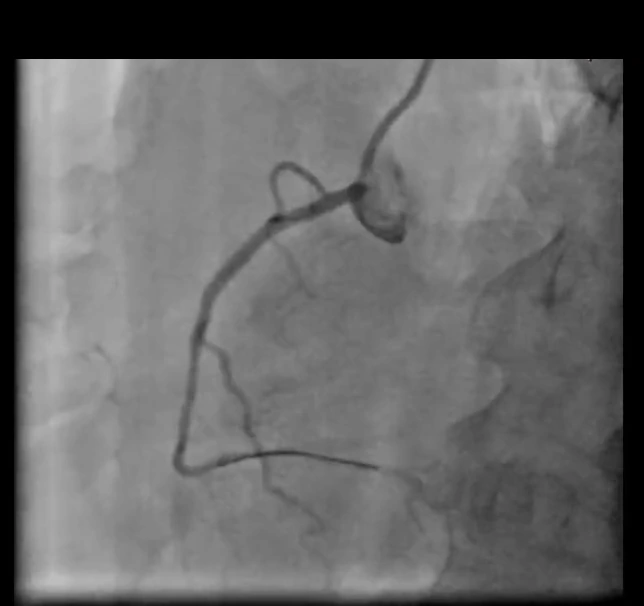 Final angiogram showing restored antegrade flow through the right coronary artery