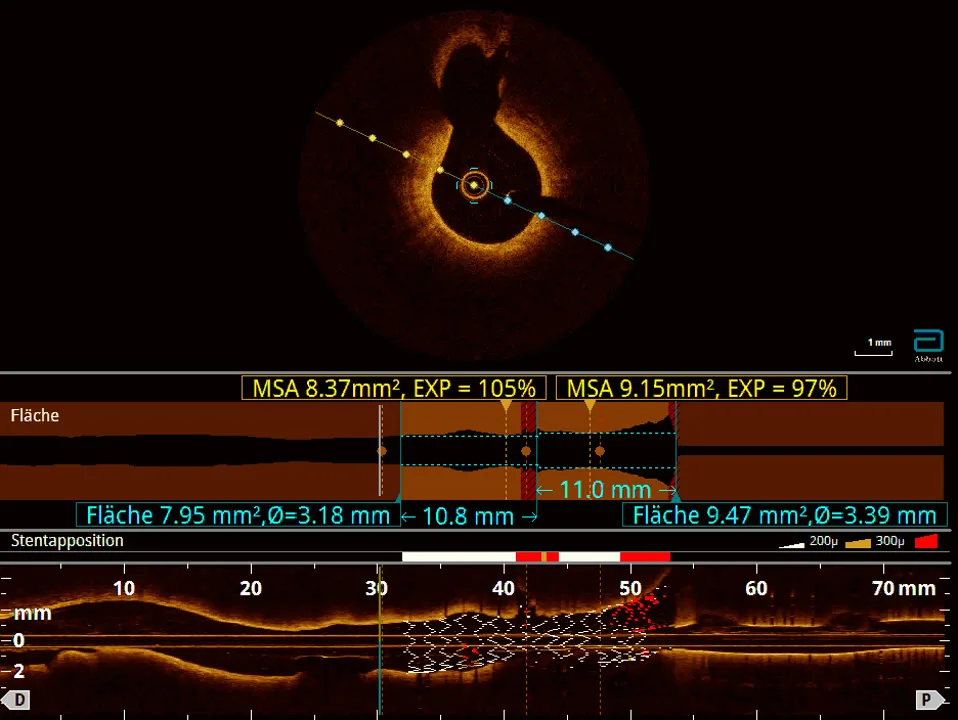 Coronary imaging in the cardiac catheterisation laboratory