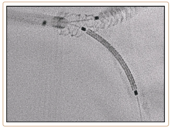 Fluoroscopic image of simultaneous kissing balloon inflation at the left main bifurcation