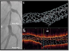 Pre-PCI and post-PCI angiography with OCT confirmation of a single-stent left main result