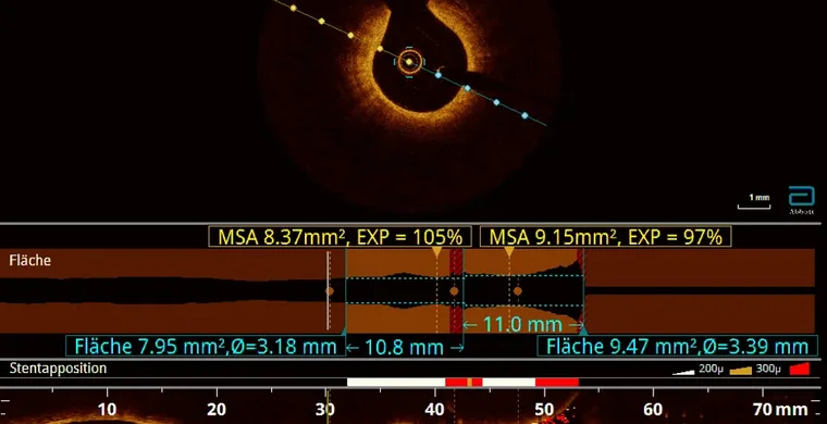 Coronary angiography imaging in the cardiac catheterisation laboratory