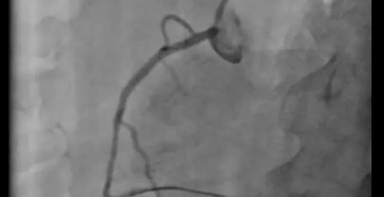 Angiogram showing restored flow through a recanalised right coronary artery