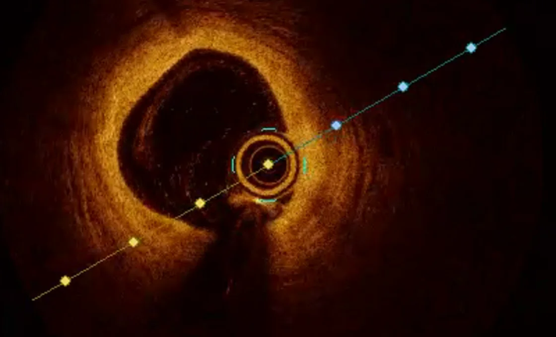 Optical coherence tomography cross-section of a coronary artery